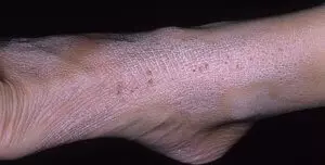 шелушение кожи при нейродермите