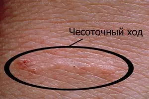 чесоточный ход