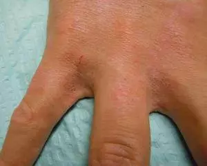 чесотка между пальцами