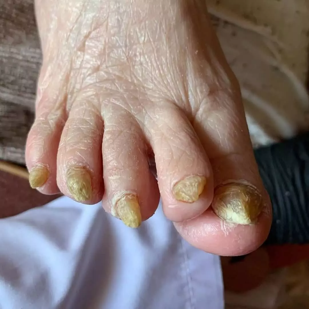 Стадии грибка ногтей