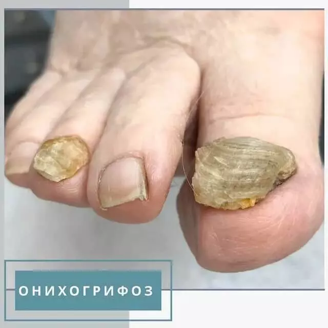 Стадии грибка ногтей