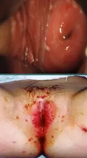 Генитальный герпес - влияние на беременность