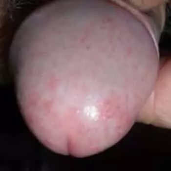 Кандидозный баланопостит