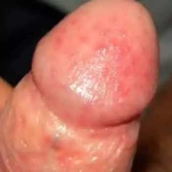 Кандидозный баланопостит