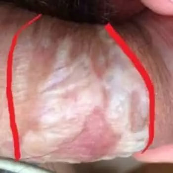 Кандидозный баланопостит