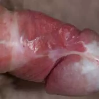 Кандидозный баланопостит