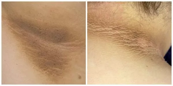 Паховая эпидермофития