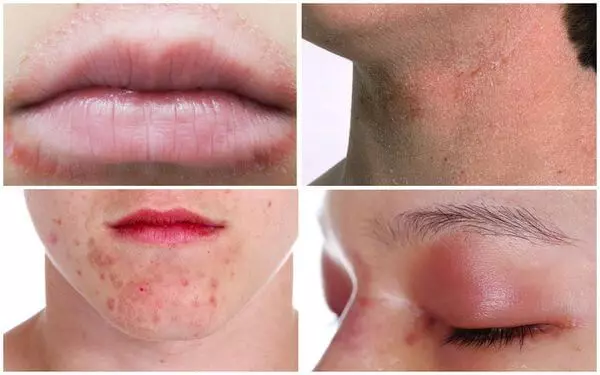 Лечение дерматита