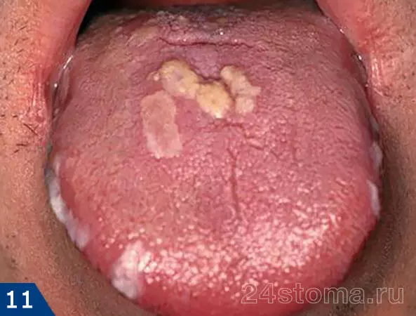 Кандидоз полости рта