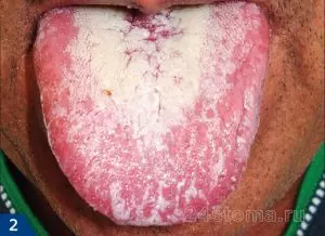 Кандидоз полости рта