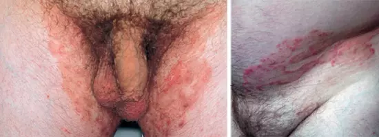 Паховая эпидермофития