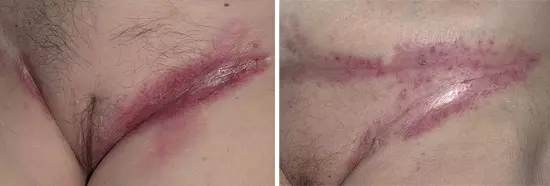 Паховая эпидермофития