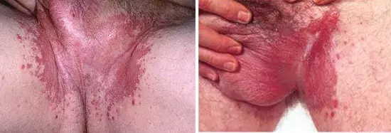 Паховая эпидермофития