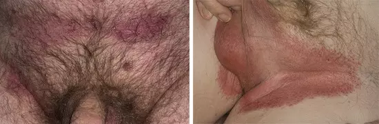 Паховая эпидермофития