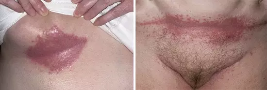 Паховая эпидермофития