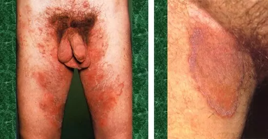 Паховая эпидермофития