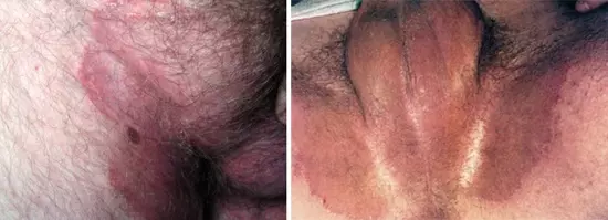 Паховая эпидермофития