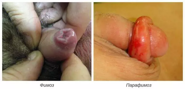 Кандидозный баланопостит