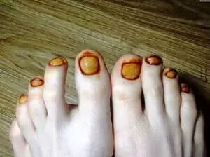 Грибковые заболевания ногтей