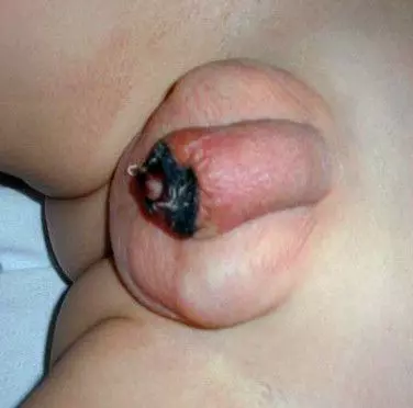 Кандидозный баланопостит