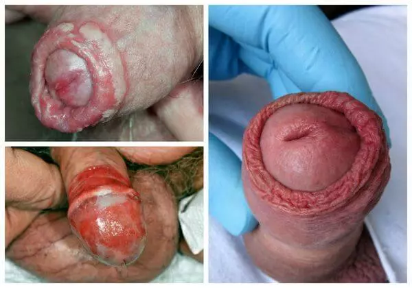 Кандидозный баланопостит