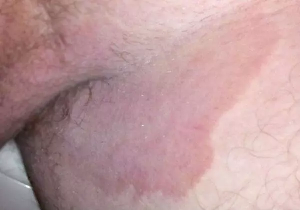 Паховая эпидермофития