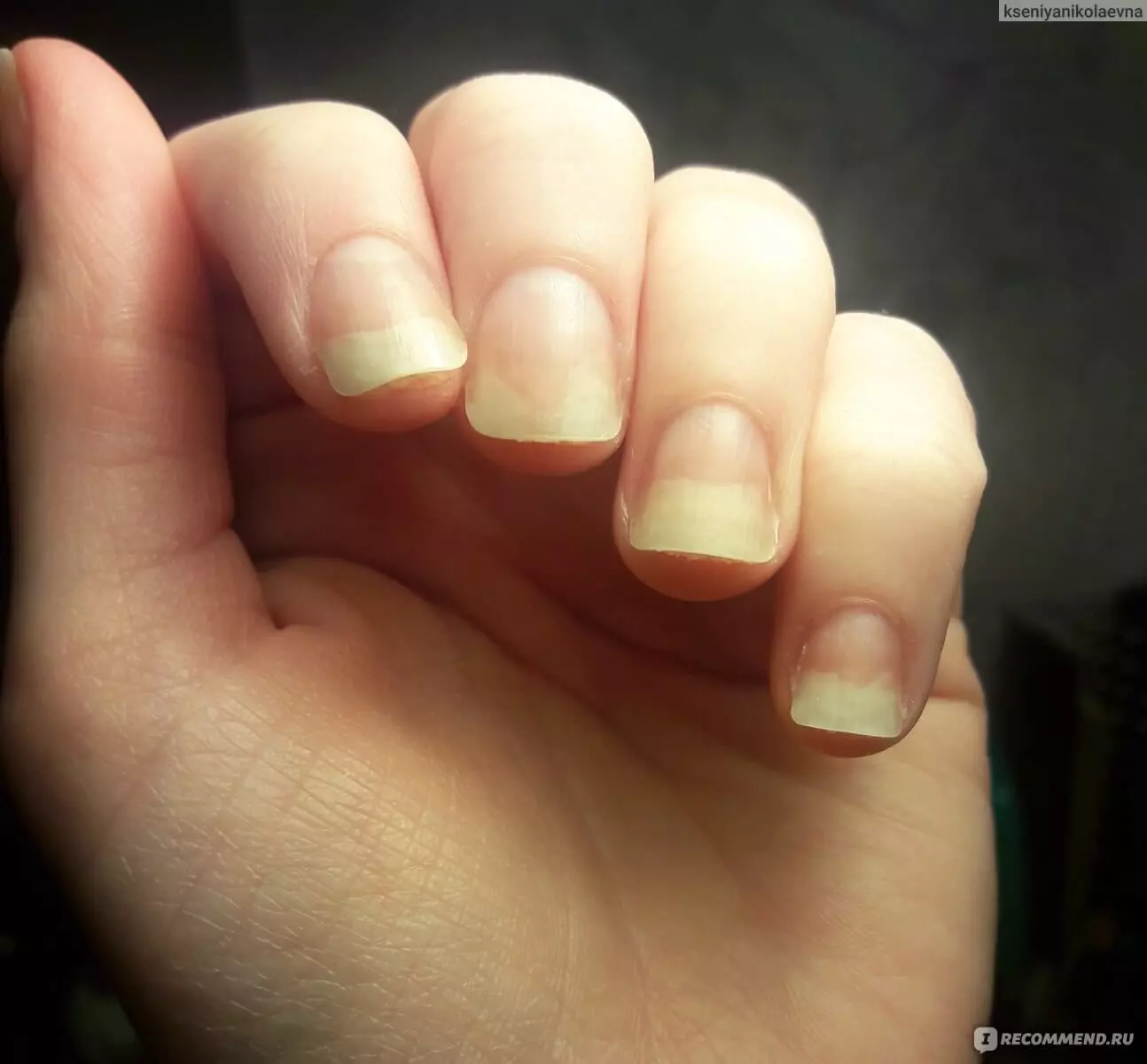 Грибковые заболевания ногтей