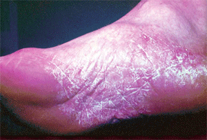 Микозы ног - грибковая инфекция ногтей и стоп