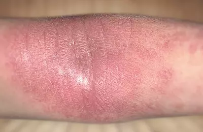 Что мы знаем про герпес