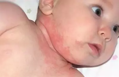 Что мы знаем про герпес