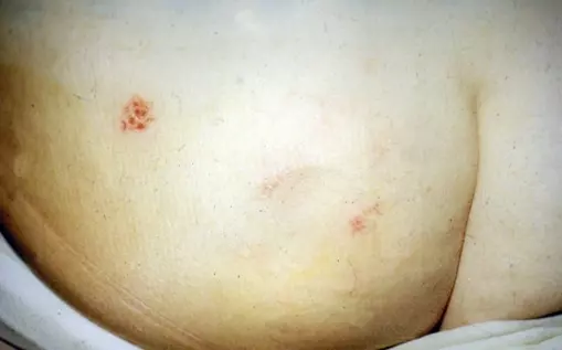 Что мы знаем про герпес