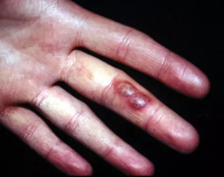 Что мы знаем про герпес