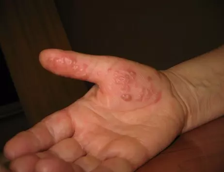 Что мы знаем про герпес