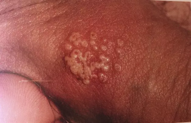 Что мы знаем про герпес