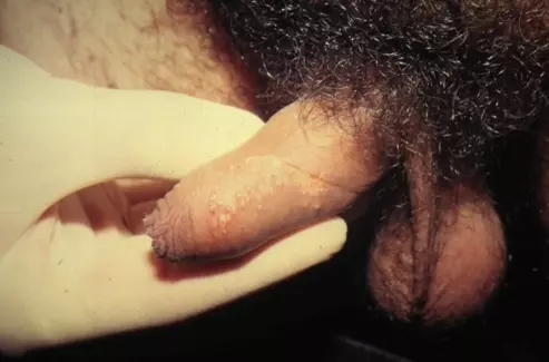 Что мы знаем про герпес