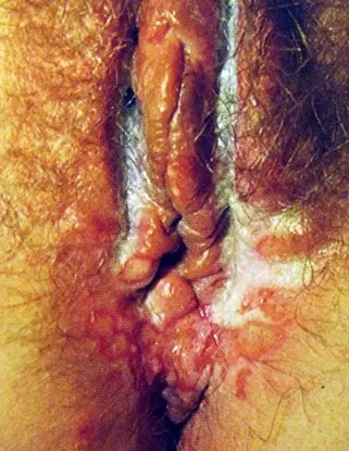 Что мы знаем про герпес