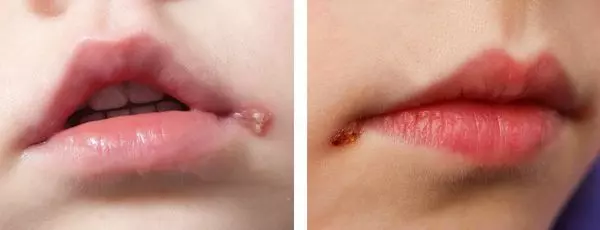 Герпес. Просто о научном