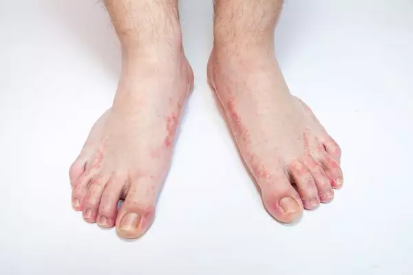 Микозы ног - грибковая инфекция ногтей и стоп