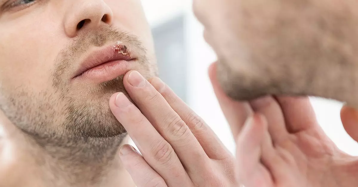 Что мы знаем про герпес