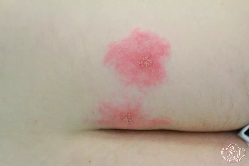 Что мы знаем про герпес