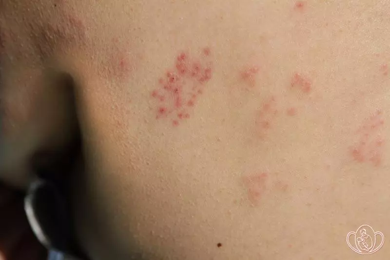 Что мы знаем про герпес