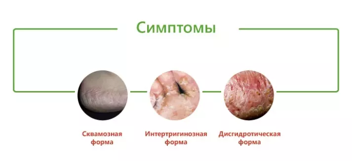 Микозы ног - грибковая инфекция ногтей и стоп