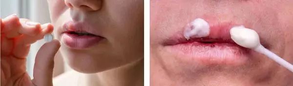 Что мы знаем про герпес