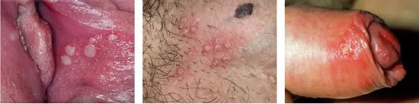 Герпес. Просто о научном