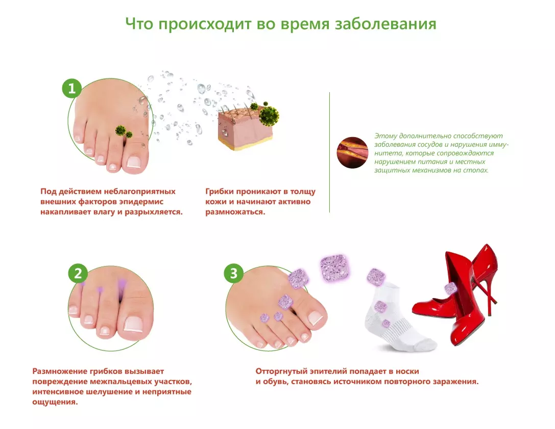 Микозы ног - грибковая инфекция ногтей и стоп