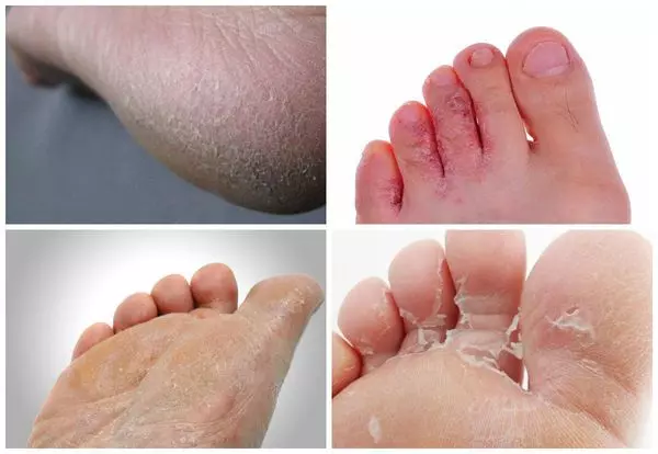 Микозы ног - грибковая инфекция ногтей и стоп